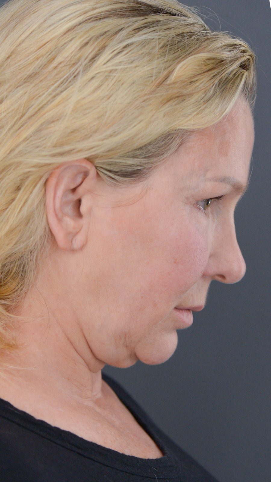 Ponytail Facelift before and after, case 09, view 3 (before)