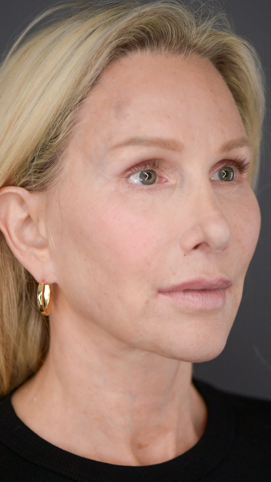 Ponytail Facelift before and after, case 09, view 4 (after)