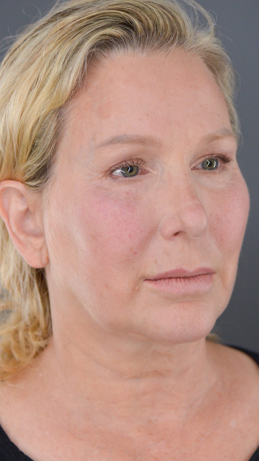 Ponytail Facelift before and after, case 09, view 4 (before)