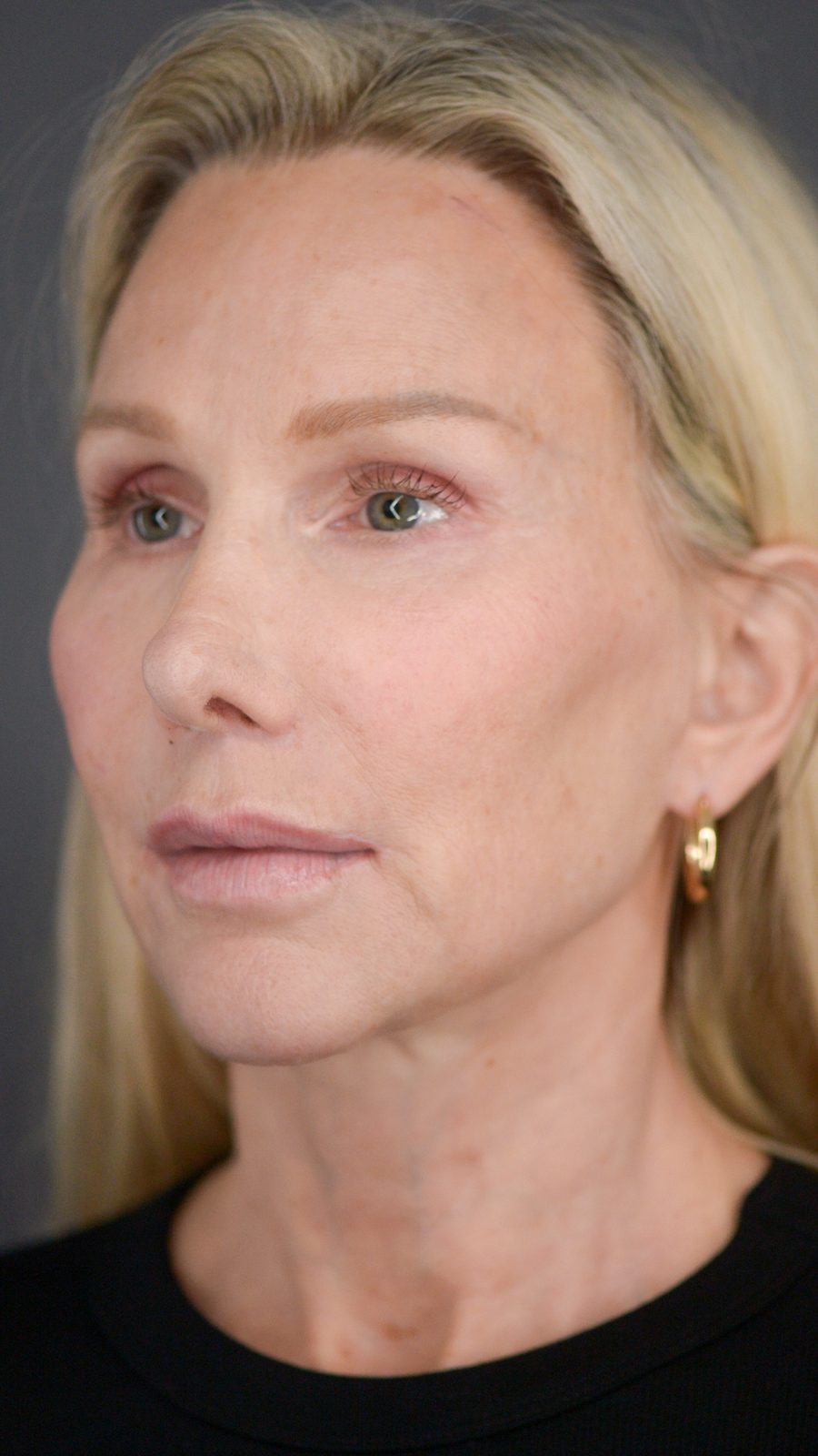 Ponytail Facelift before and after, case 09, view 5 (after)