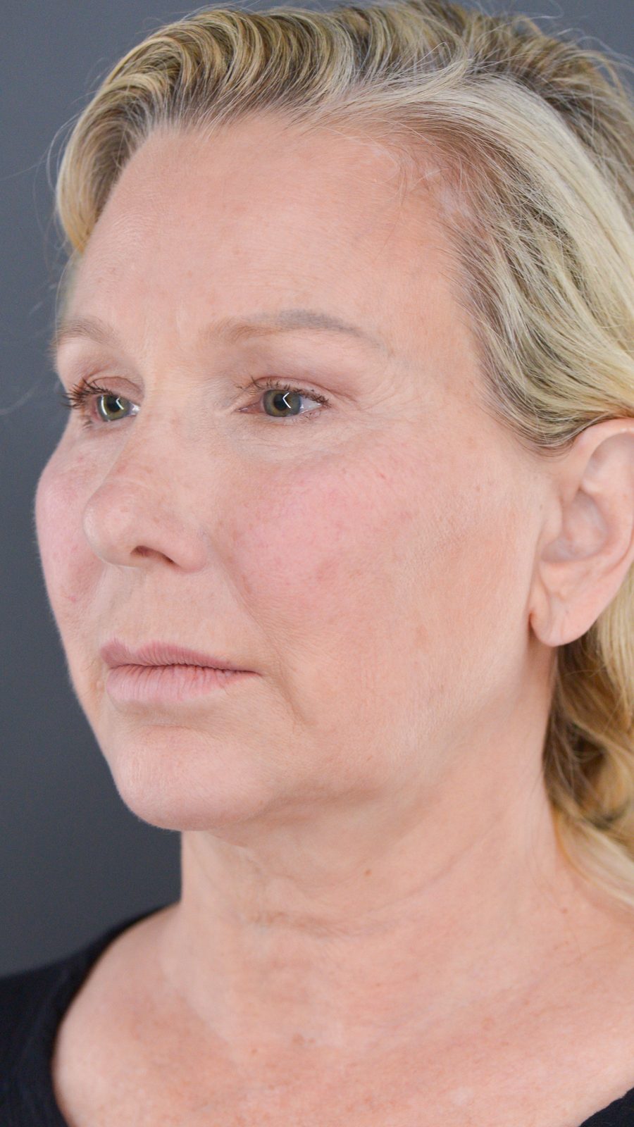 Ponytail Facelift before and after, case 09, view 5 (before)