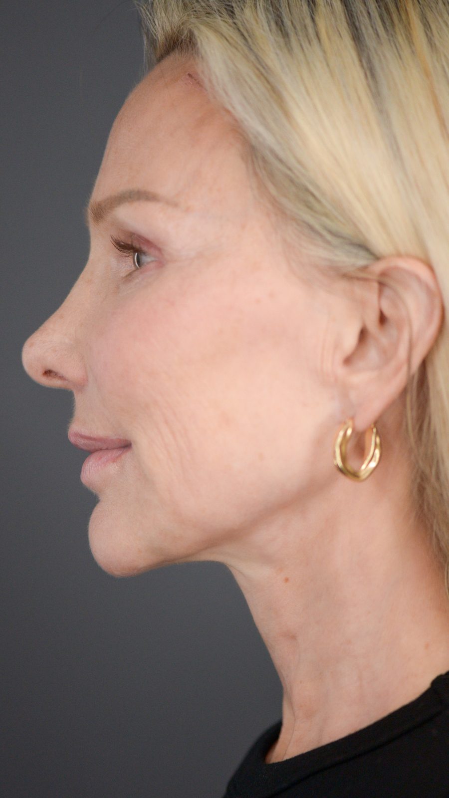 Ponytail Facelift before and after, case 09, view 6 (after)
