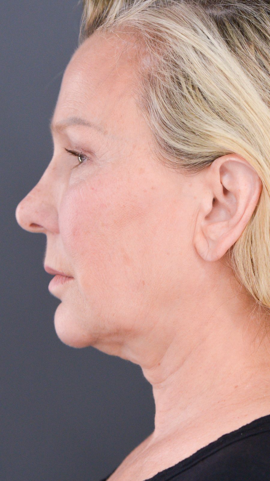 Ponytail Facelift before and after, case 09, view 6 (before)