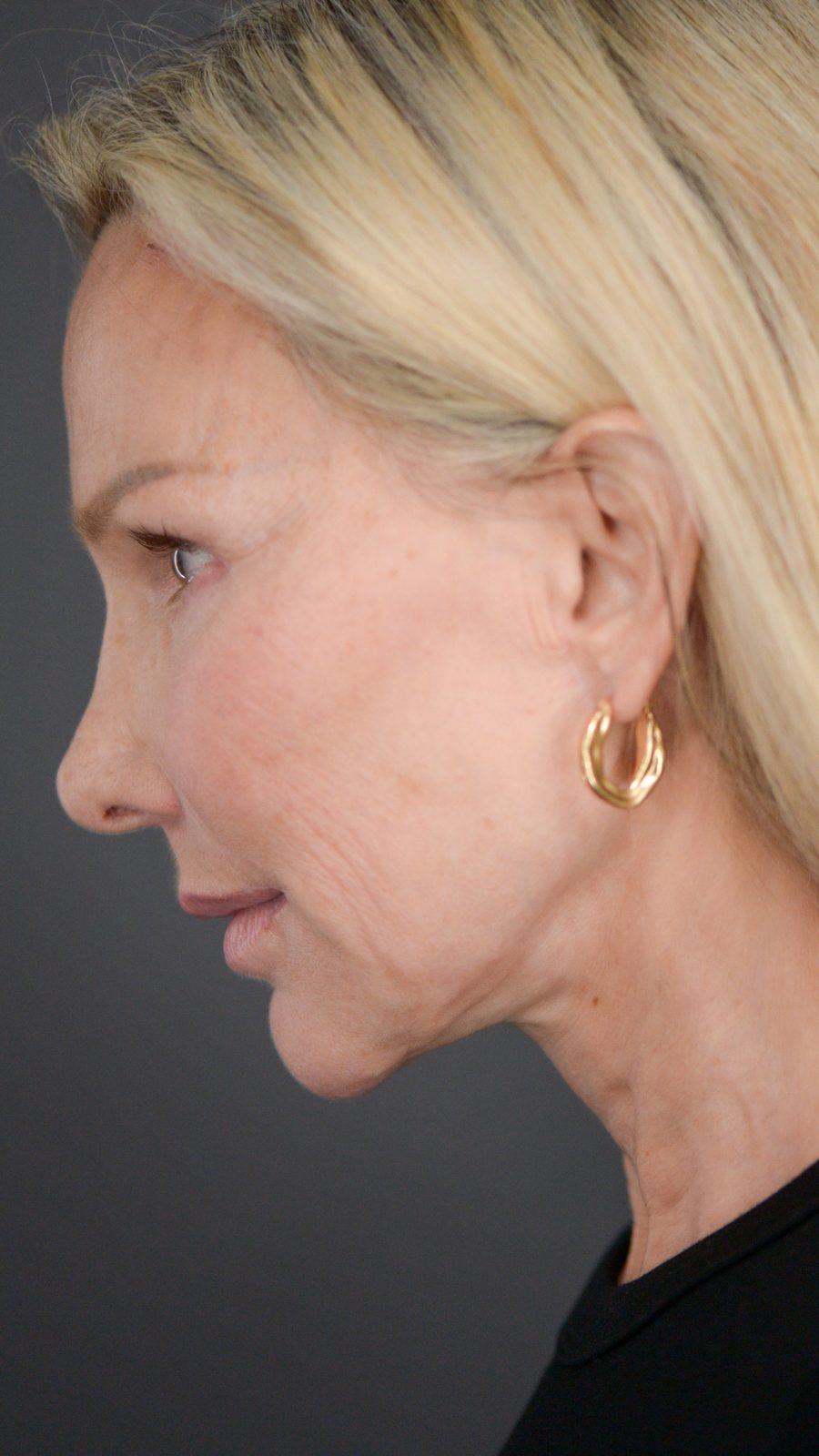 Ponytail Facelift before and after, case 09, view 7 (after)