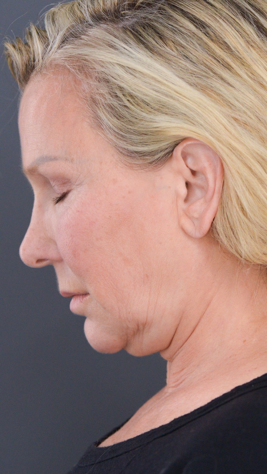 Ponytail Facelift before and after, case 09, view 7 (before)