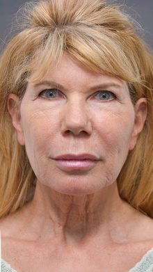Ponytail Facelift before and after, case 10 (before)