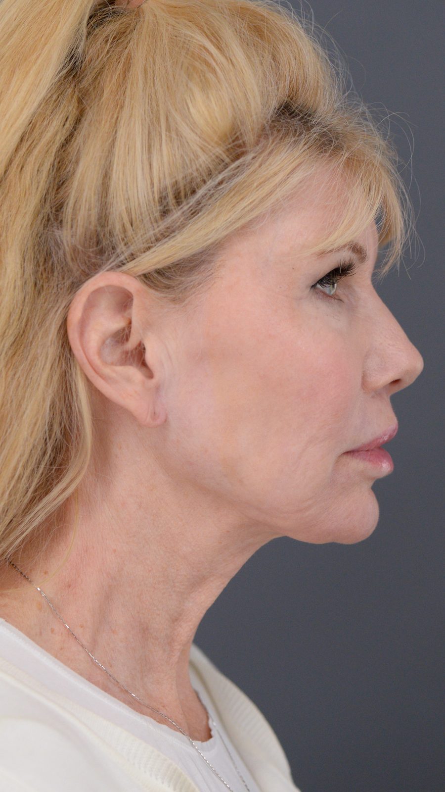 Ponytail Facelift before and after, case 10, view 3 (after)