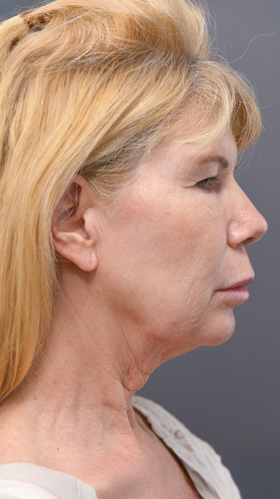 Ponytail Facelift before and after, case 10, view 3 (before)