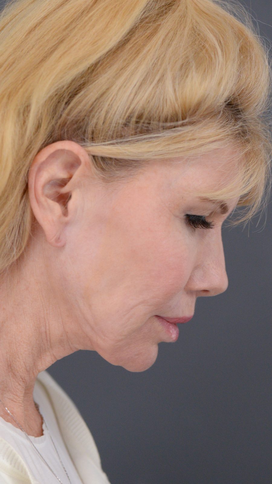 Ponytail Facelift before and after, case 10, view 4 (after)