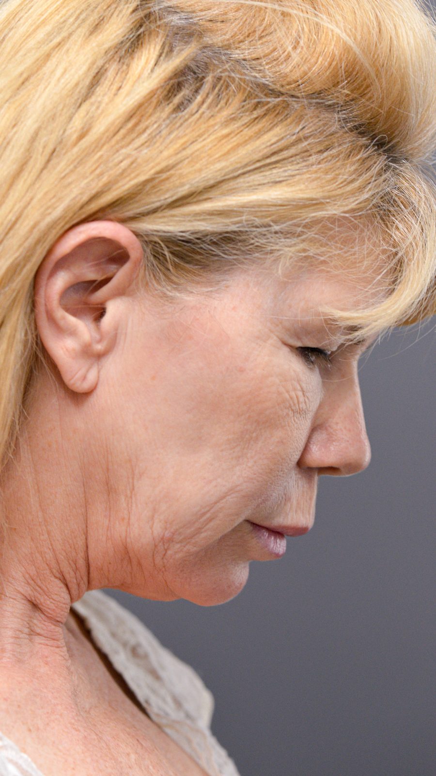 Ponytail Facelift before and after, case 10, view 4 (before)