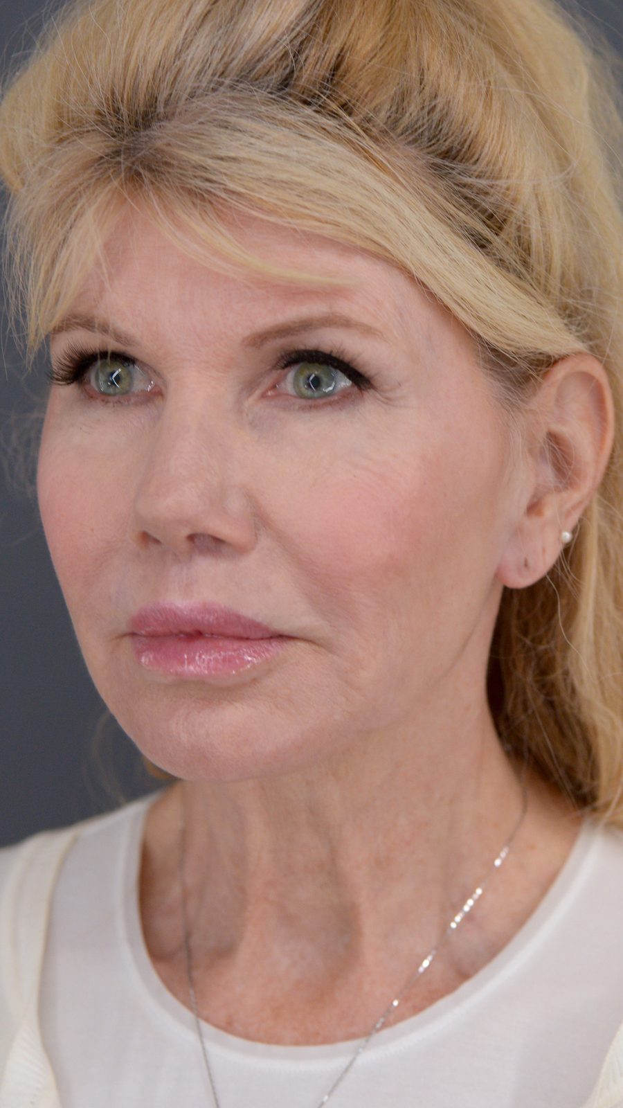 Ponytail Facelift before and after, case 10, view 5 (after)