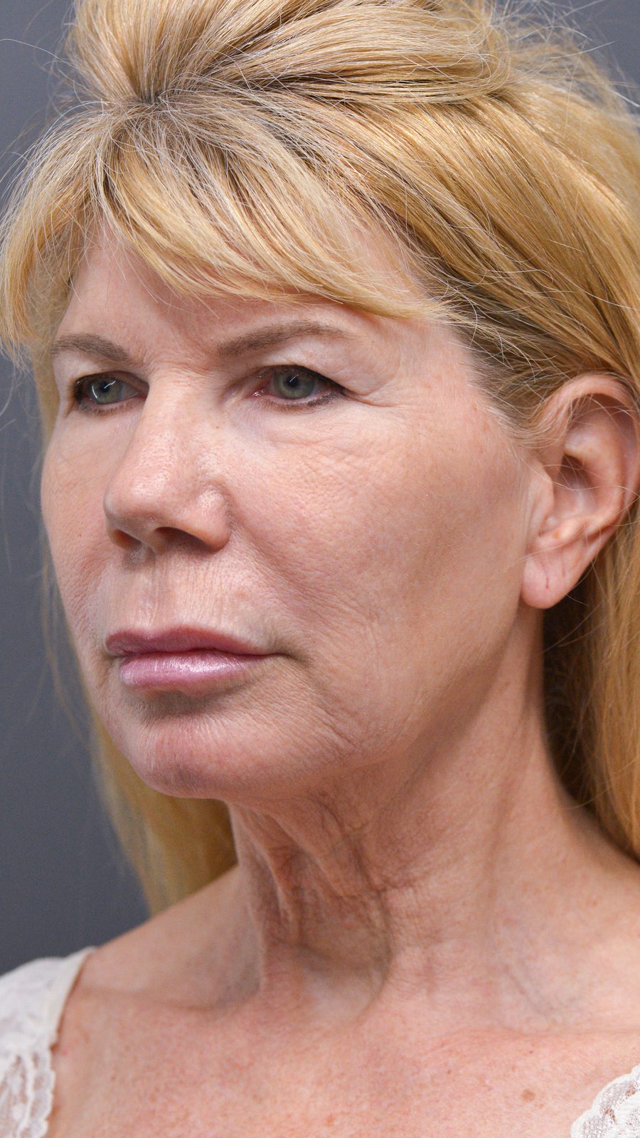 Ponytail Facelift before and after, case 10, view 5 (before)