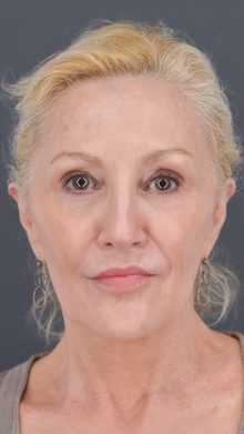 Ponytail Facelift before and after, case 11 (after)