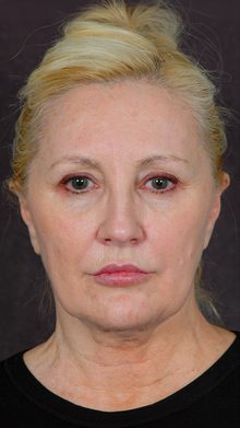 Ponytail Facelift before and after, case 11 (before)
