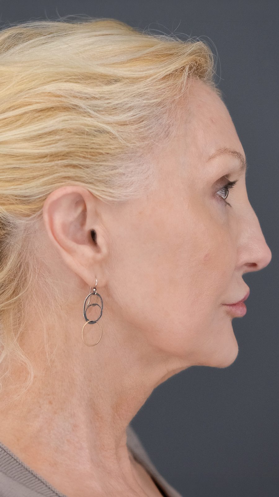 Ponytail Facelift before and after, case 11, view 3 (after)
