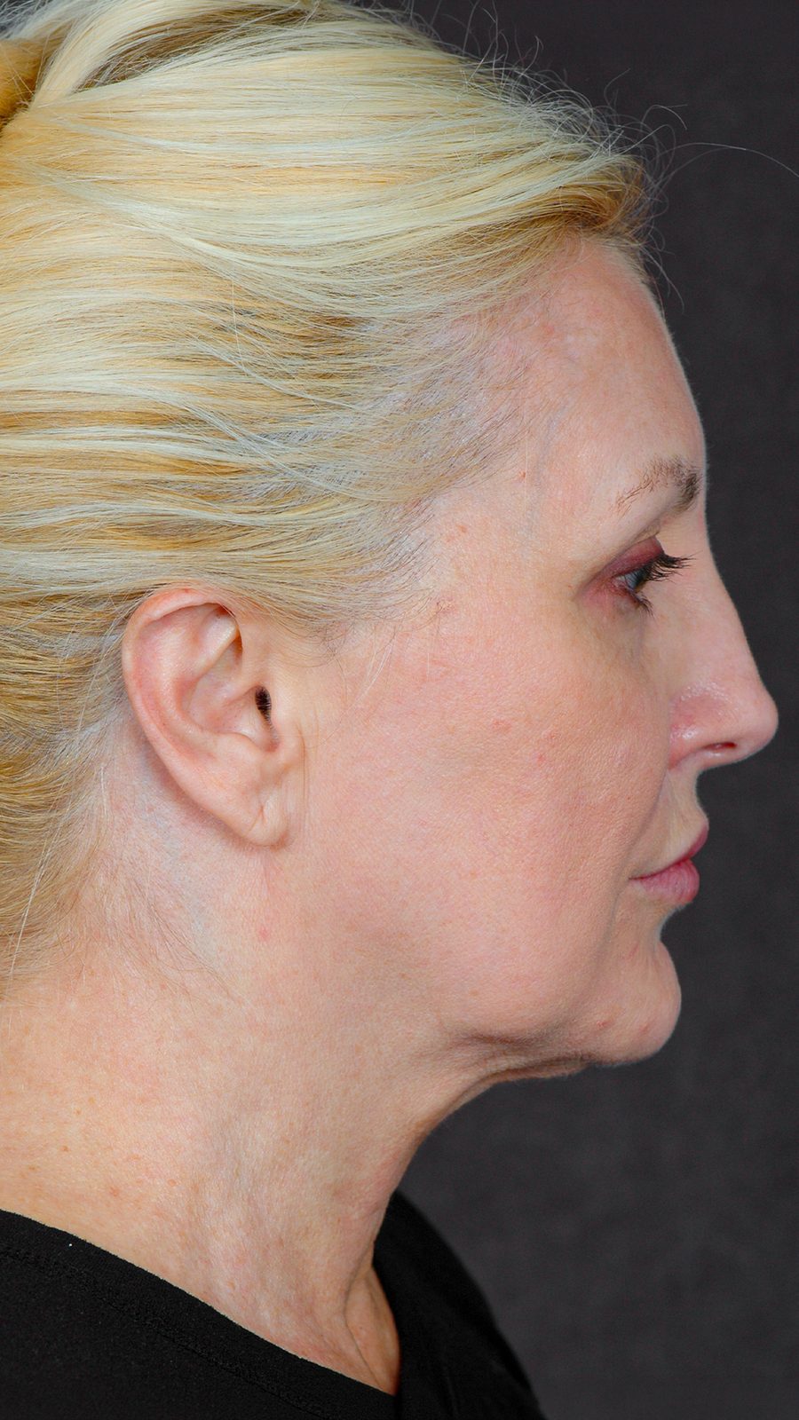 Ponytail Facelift before and after, case 11, view 3 (before)