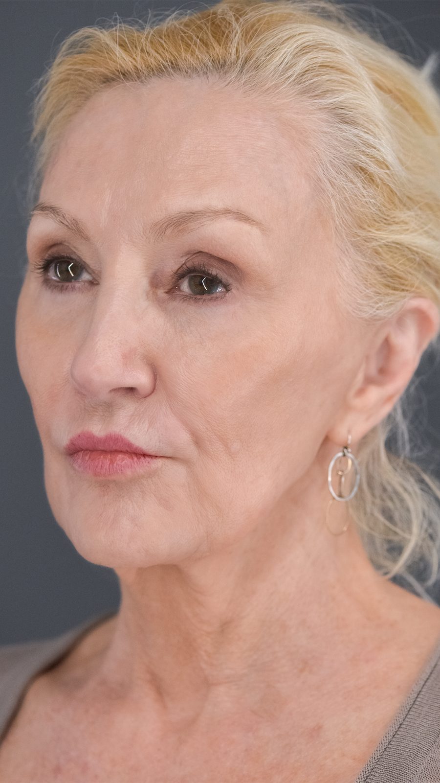 Ponytail Facelift before and after, case 11, view 4 (after)