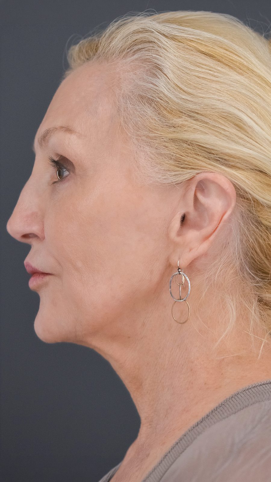 Ponytail Facelift before and after, case 11, view 5 (after)