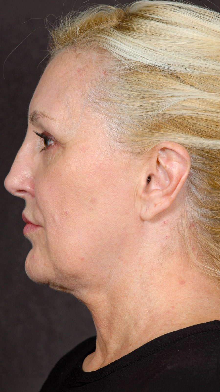 Ponytail Facelift before and after, case 11, view 5 (before)