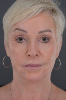 Ponytail Facelift before and after, case 12 (after)