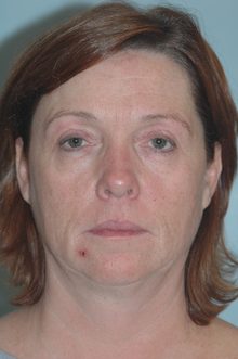 Ponytail Facelift before and after, case 12 (before)