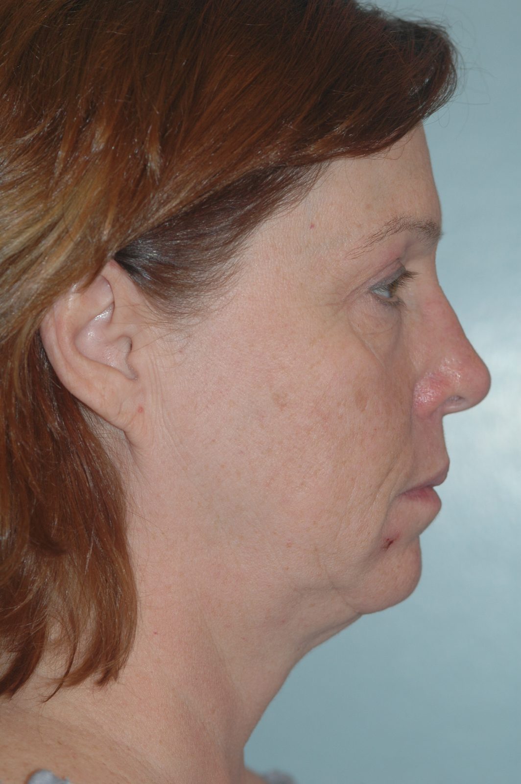 Ponytail Facelift before and after, case 12, view 3 (before)