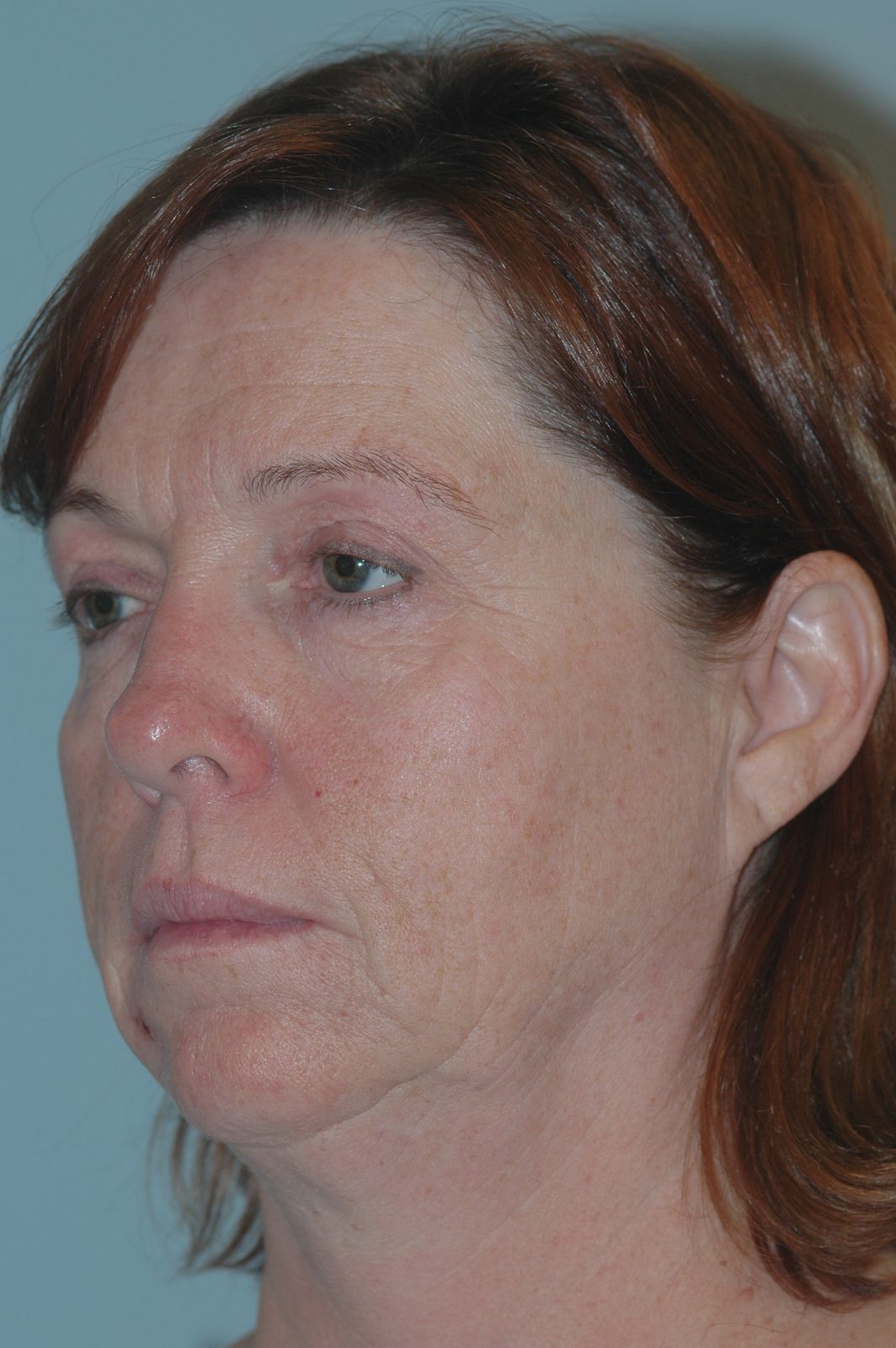 Ponytail Facelift before and after, case 12, view 4 (before)
