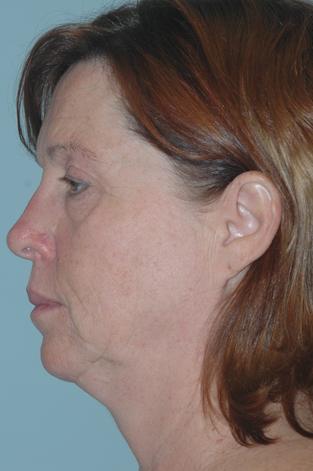 Ponytail Facelift before and after, case 12, view 5 (before)