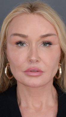 Ponytail Facelift before and after, case 13 (after)