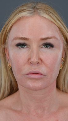 Ponytail Facelift before and after, case 13 (before)