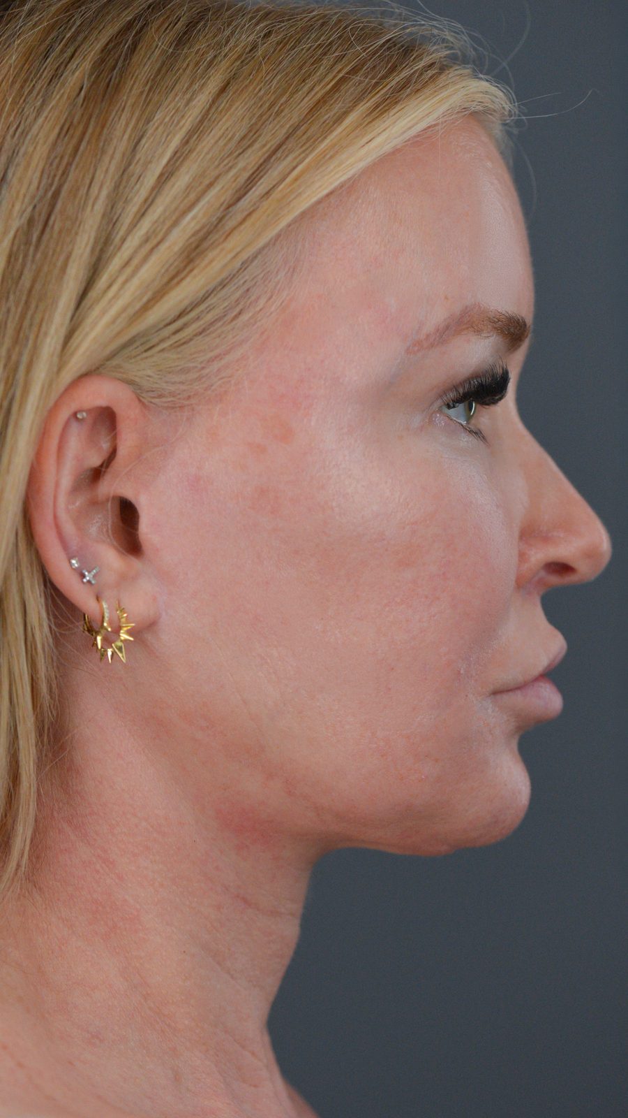 Ponytail Facelift before and after, case 13, view 3 (before)