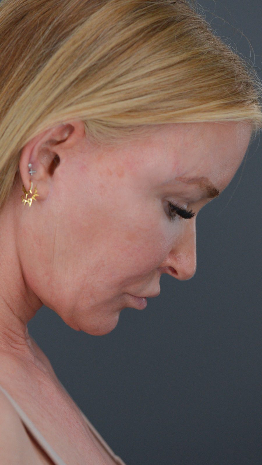 Ponytail Facelift before and after, case 13, view 4 (before)