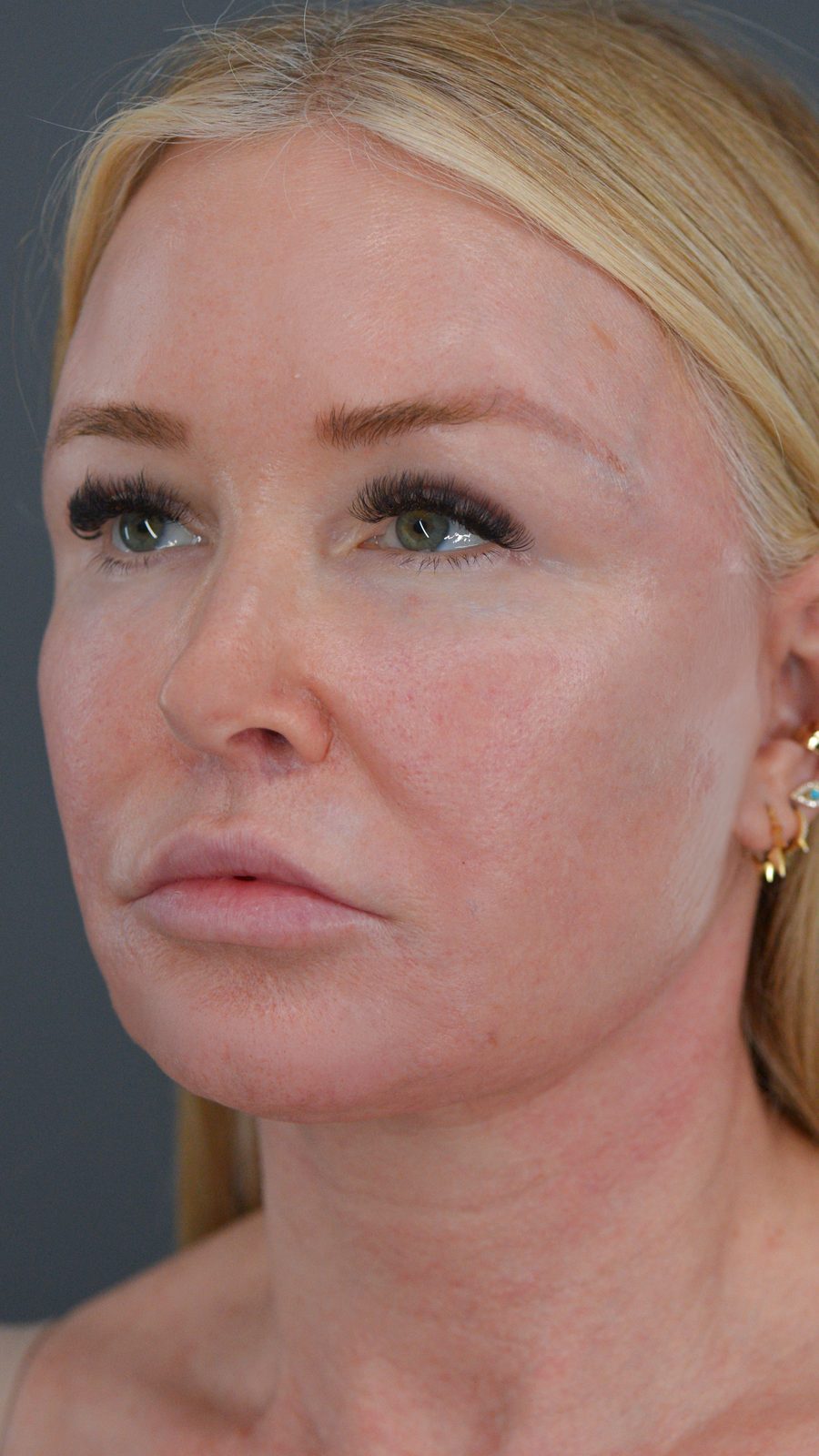 Ponytail Facelift before and after, case 13, view 5 (before)