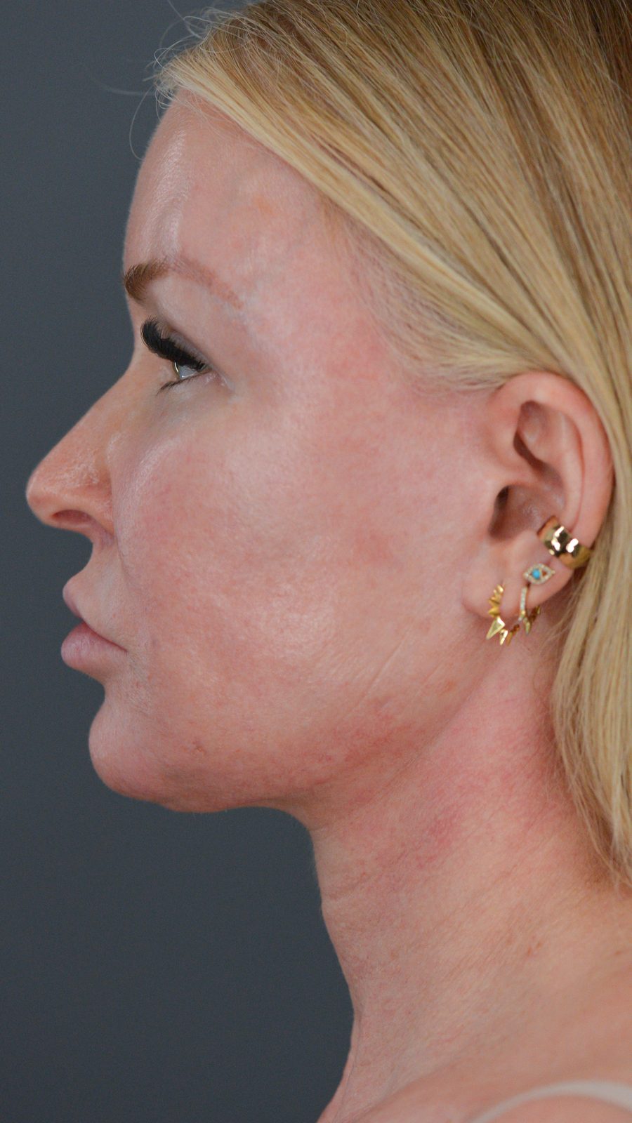 Ponytail Facelift before and after, case 13, view 6 (before)