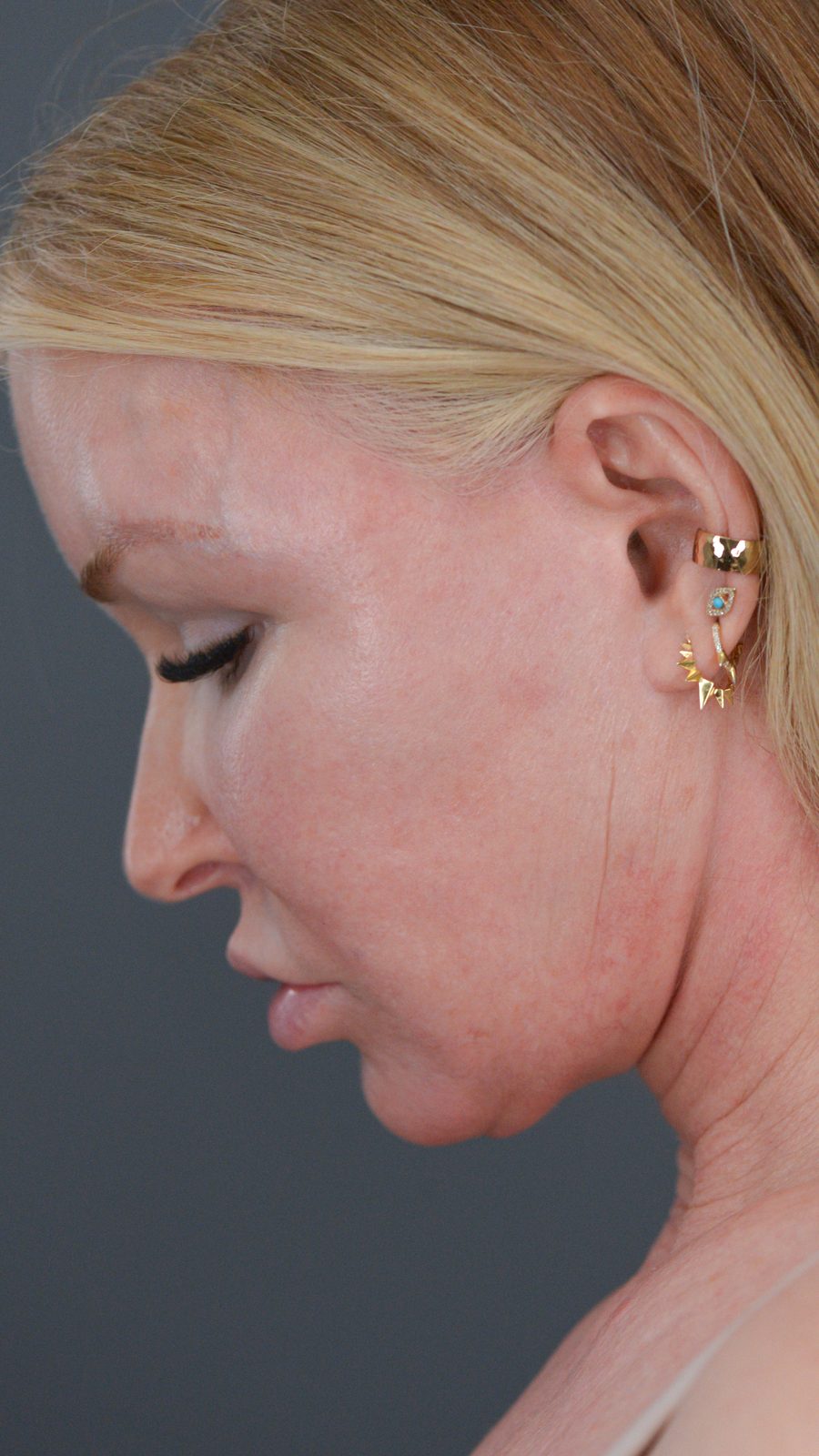 Ponytail Facelift before and after, case 13, view 7 (before)