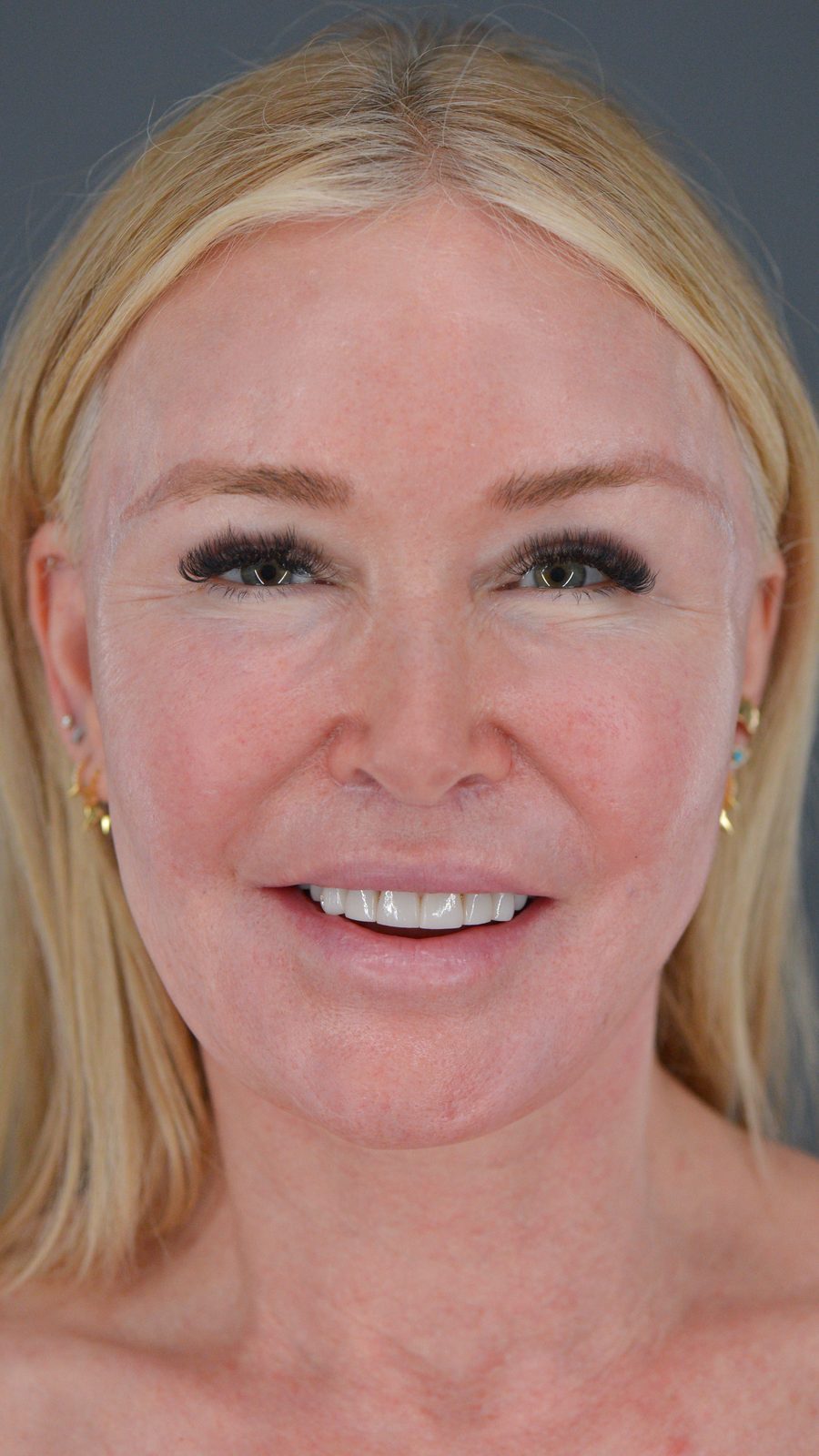 Ponytail Facelift before and after, case 13, view 8 (before)