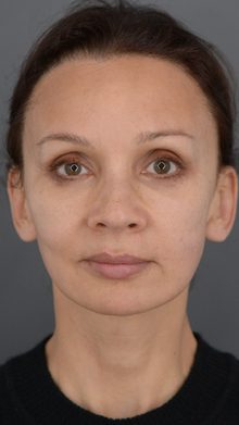 Ponytail Facelift before and after, case 14 (after)