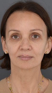 Ponytail Facelift before and after, case 14 (before)