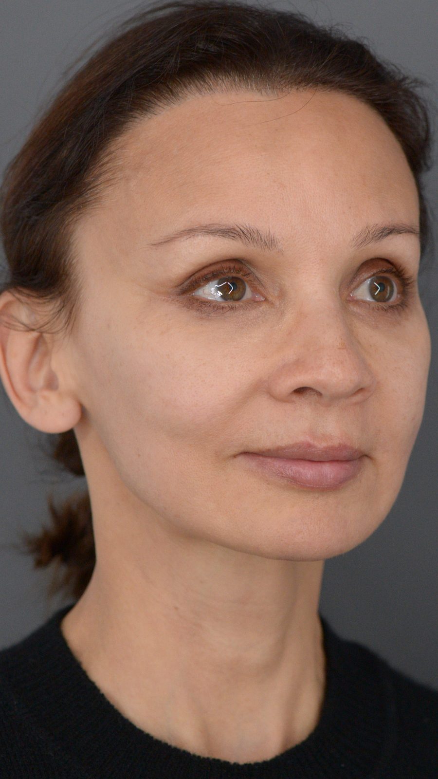 Ponytail Facelift before and after, case 14, view 3 (after)