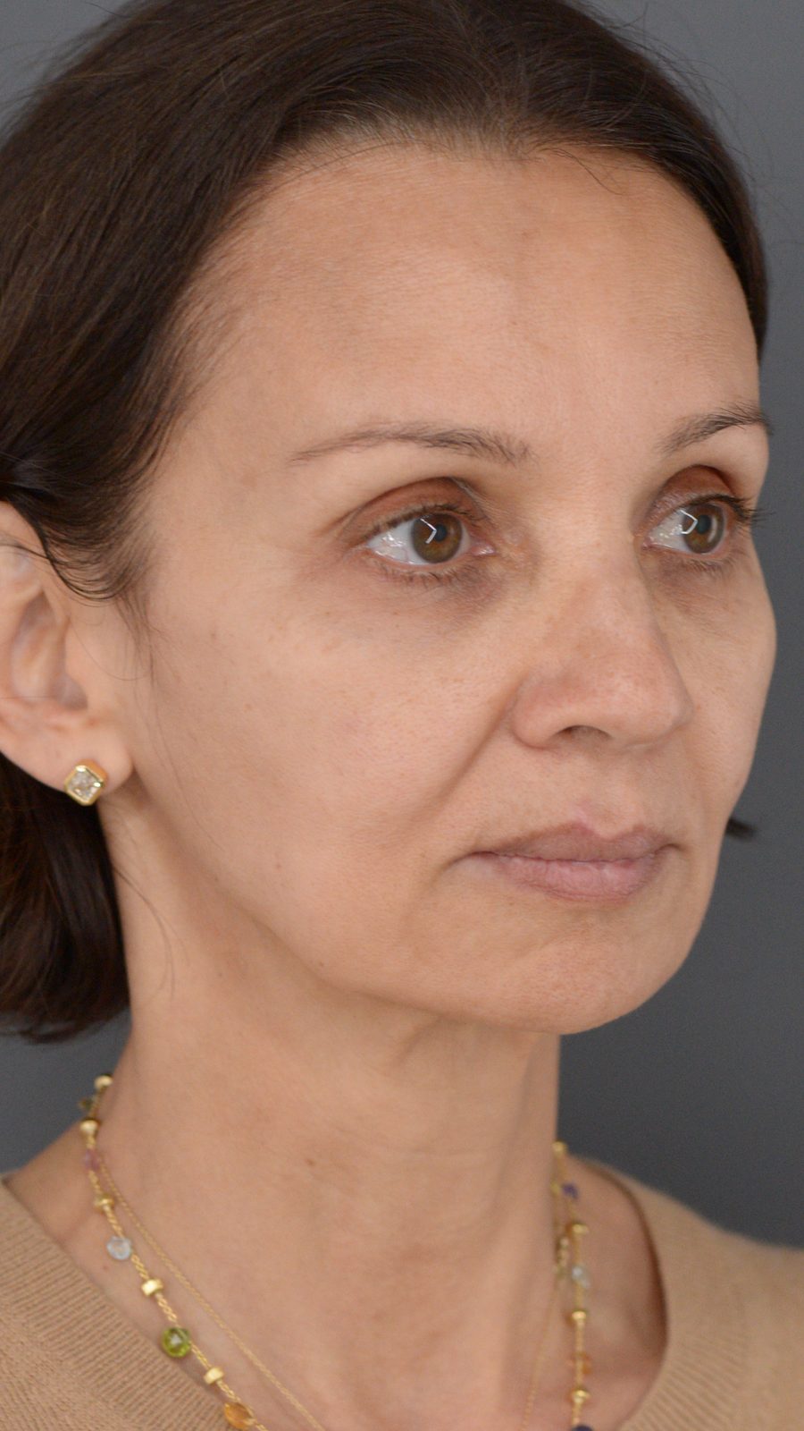 Ponytail Facelift before and after, case 14, view 3 (before)