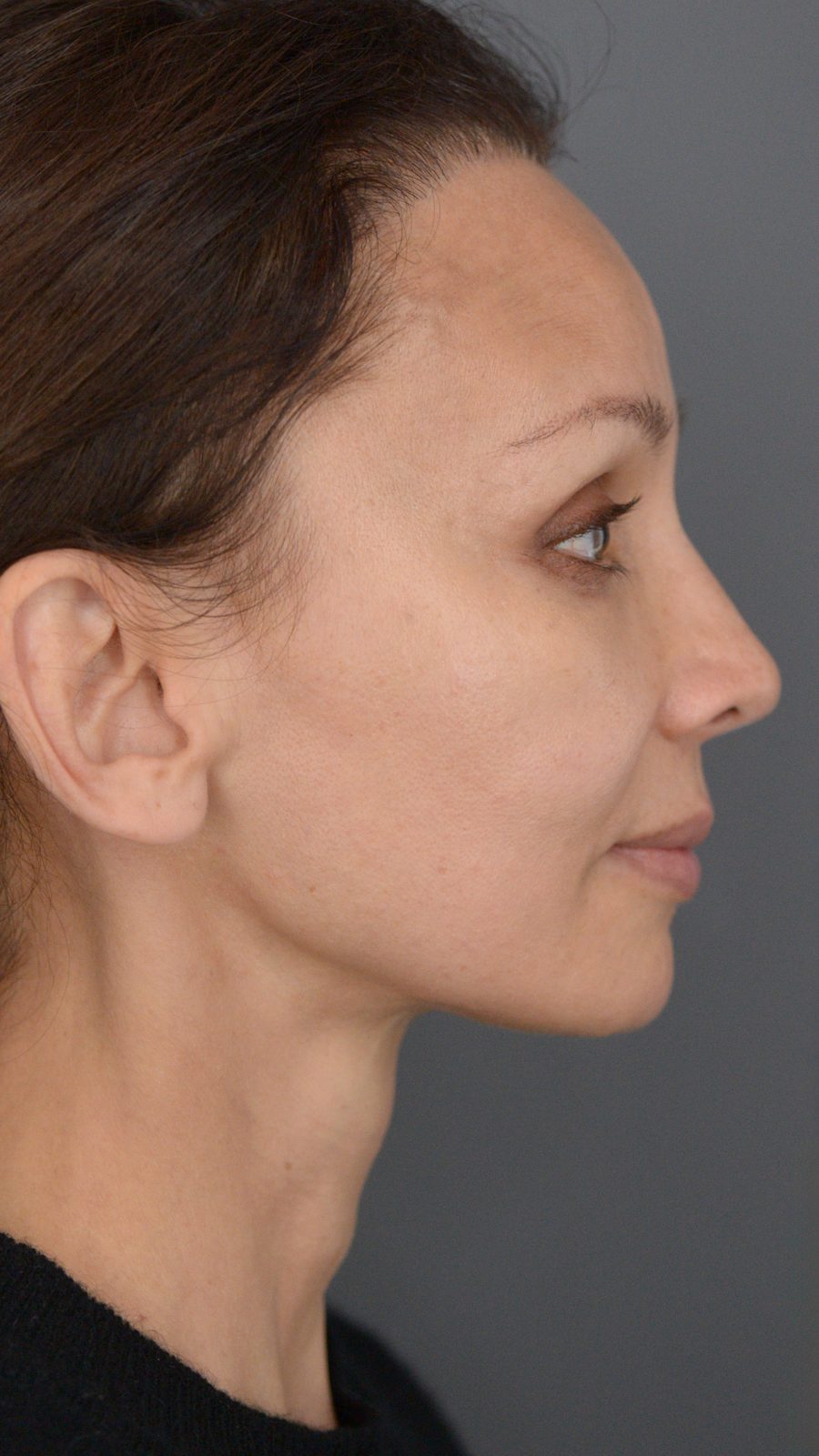 Ponytail Facelift before and after, case 14, view 4 (after)