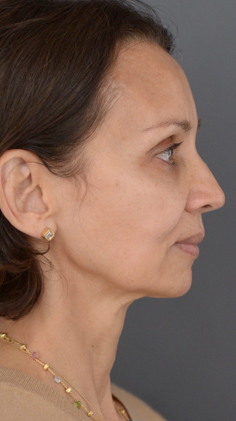 Ponytail Facelift before and after, case 14, view 4 (before)