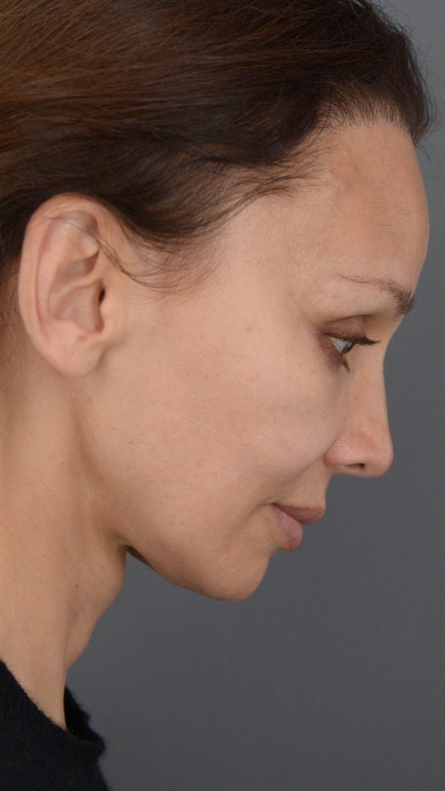 Ponytail Facelift before and after, case 14, view 5 (after)