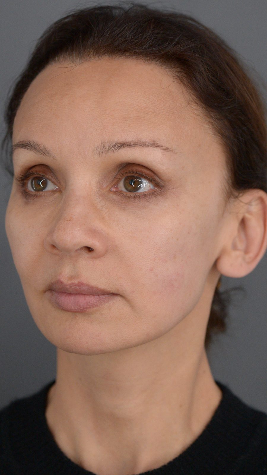 Ponytail Facelift before and after, case 14, view 6 (after)