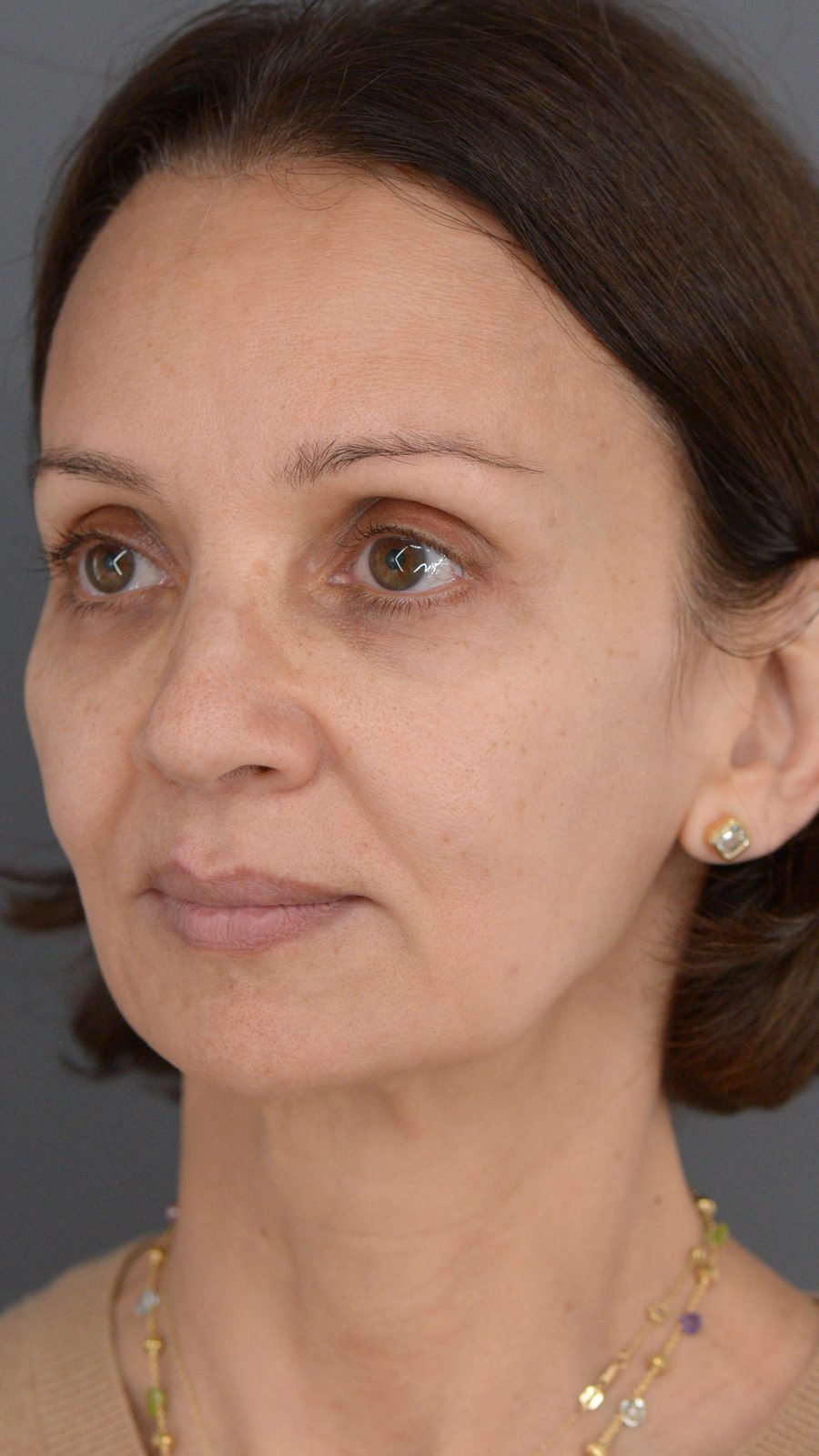 Ponytail Facelift before and after, case 14, view 6 (before)