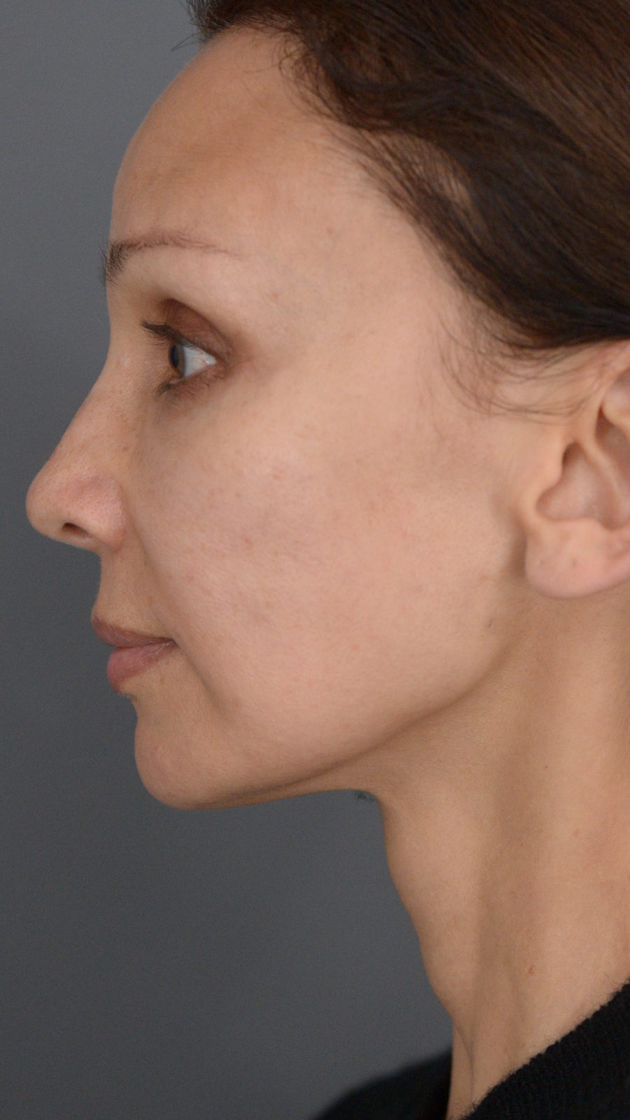Ponytail Facelift before and after, case 14, view 7 (after)