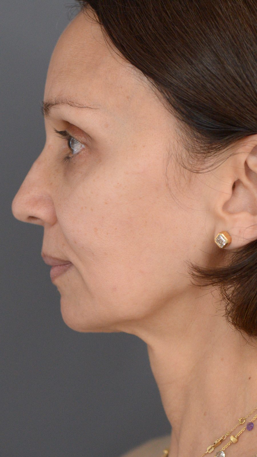 Ponytail Facelift before and after, case 14, view 7 (before)