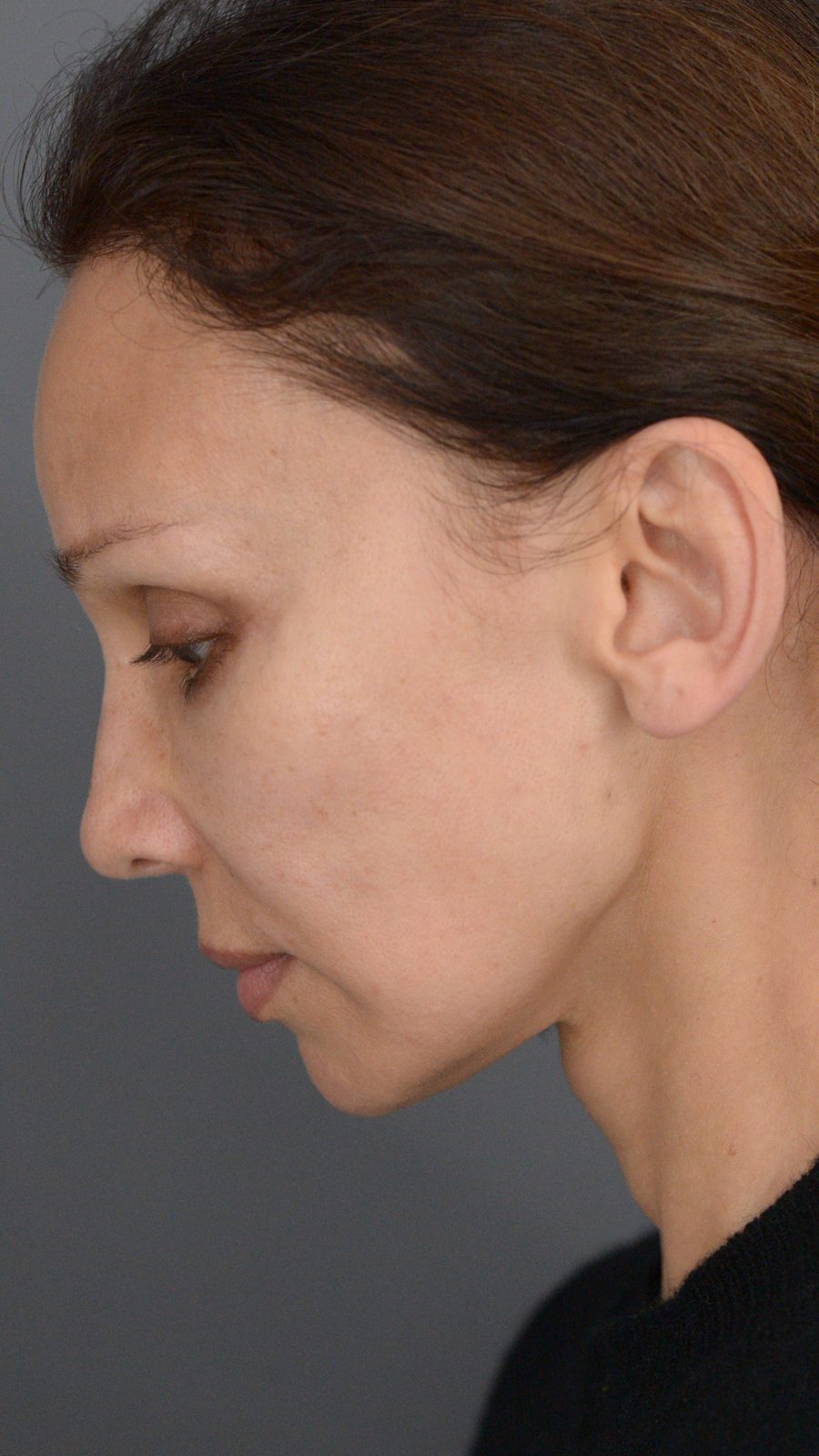 Ponytail Facelift before and after, case 14, view 8 (after)