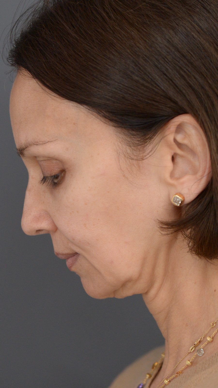 Ponytail Facelift before and after, case 14, view 8 (before)