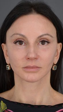 Ponytail Facelift before and after, case 15 (after)